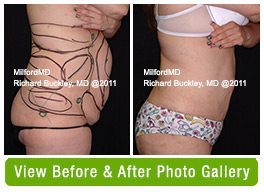 Laser Liposuction Scranton PA